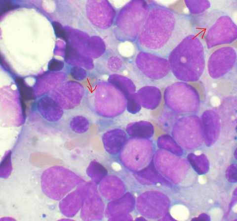 Acute myeloid leukemia cells in bone marrow