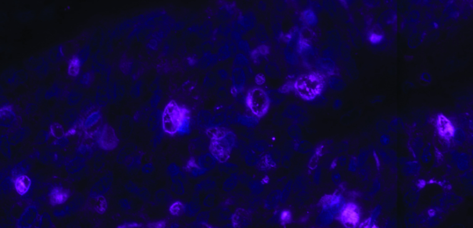 Fungi (pink) inside the cells of a human ovarian tumor (cell nuclei are in blue). (Image from the Straussman lab)