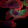 The photo above shows a group of human breast cancer cells.