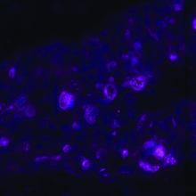Fungi (pink) inside the cells of a human ovarian tumor (cell nuclei are in blue). (Image from the Straussman lab)