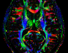 Diffusion Tensor Imaging at 7T