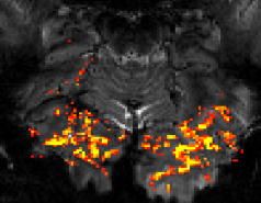 High-resolution functional MRI picture no. 2