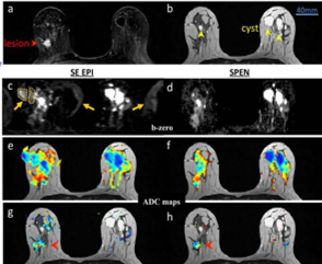 Diffusion SPEN MRI 