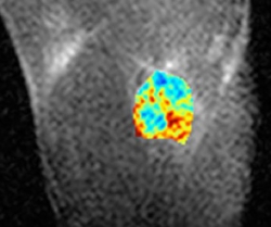 Ferritin expression in tumors