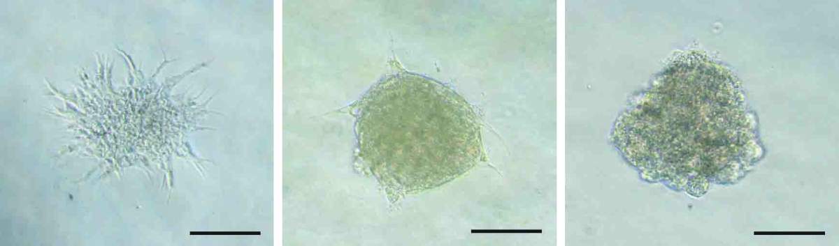 Abnormally sprouting lymph vessel cells from a KLA patient (left); the sprouting was reversed by exposure to the two drugs identified in the study (center and right)