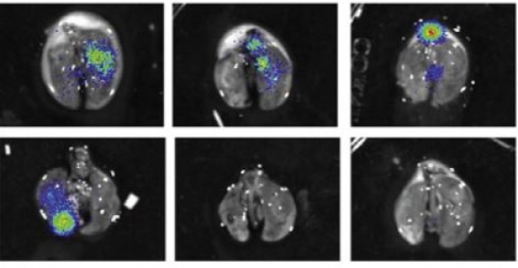 ETS Proteins Bind with Glucocorticoid Receptors: Relevance for Treatment of Ewing Sarcoma