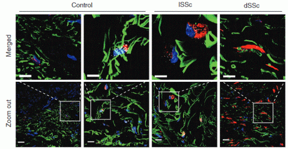 LGR5 expressing skin fibroblasts define a major cellular hub perturbed in scleroderma