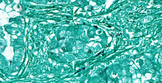 An uncommon example of fungi (black) that are present in human lung cancer tissue (turquoise) but not inside the cells. Image credit: Lian Narunsky Haziza and Nancy Gavert