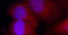 When the scientists blocked a protein that reads a zip code responsible for moving RNAs into the cytoplasm, numerous RNA molecules (bright dots) gathered instead in the cell nuclei (purple)